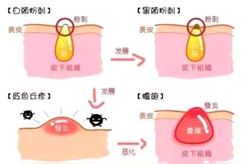 css祛闭口,闭口粉刺怎么样处理比较好